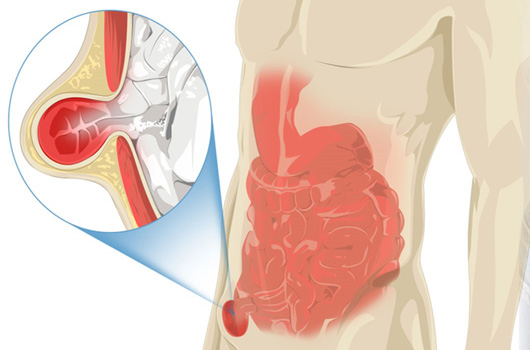 Hernia Surgery Awareness Information