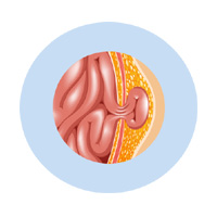 Hernia
