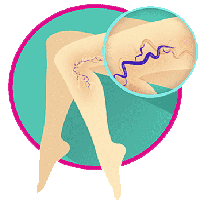 Endo Venous LASER Ablation of Varicose Veins